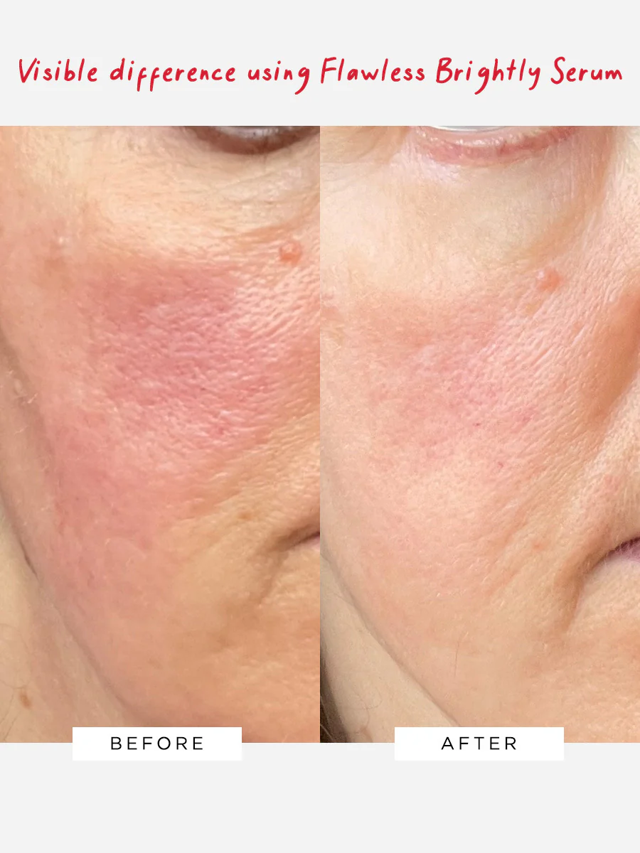 Flawless Brightly 10% Azelaic Acid Serum (HPRA - DO NOT USE) - Image 3